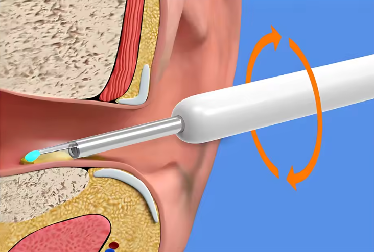 Nettoyeur d’Oreilles Visuel Sans Fil 1296P HD | Otoscope WiFi avec Caméra & 6 LED